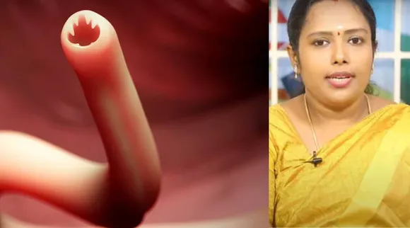 Intestinal worms